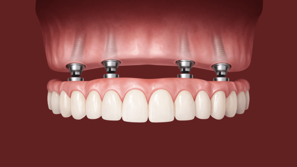 沖縄インプラントmicデンタルオールオンフォー All-on-4