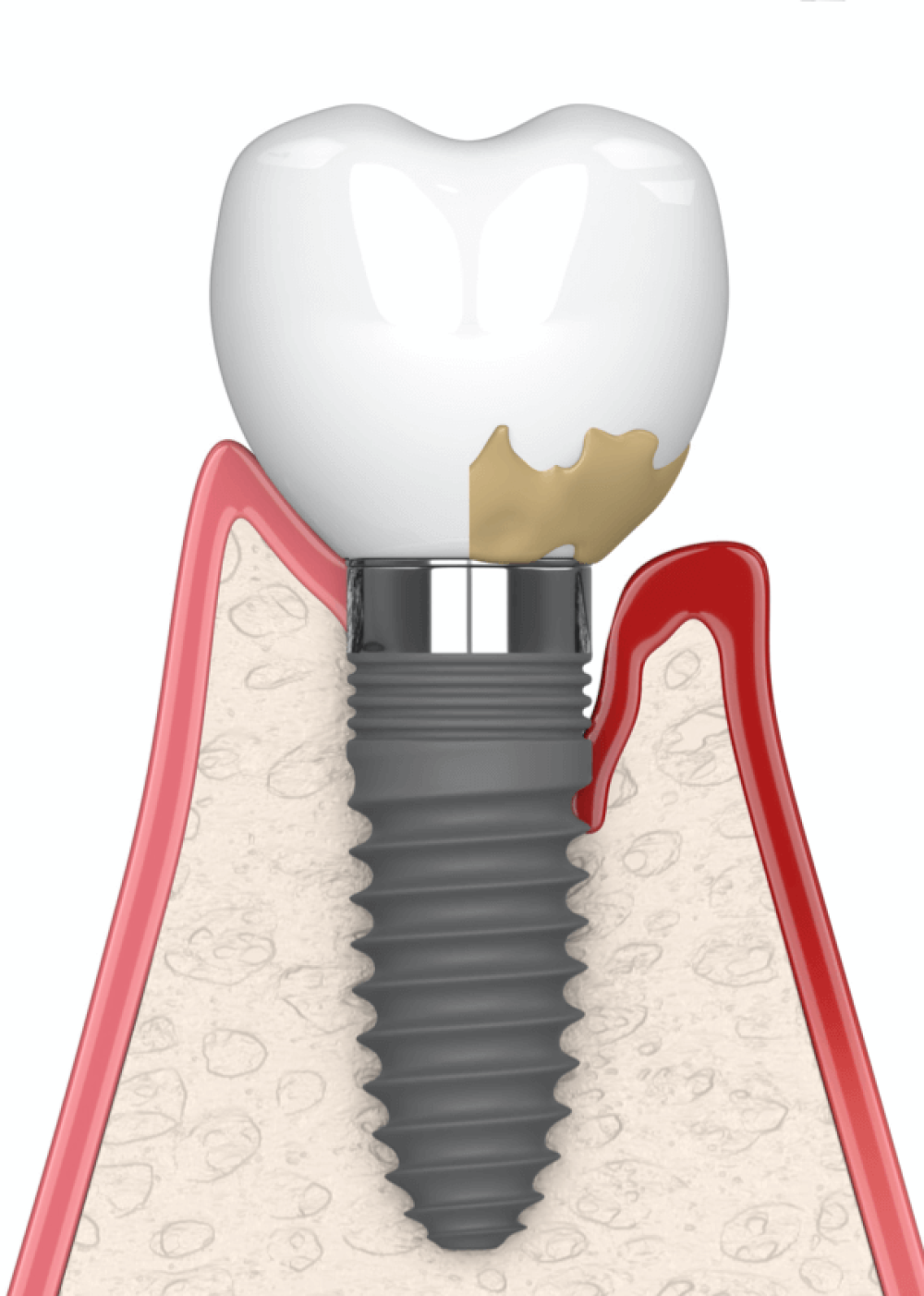 インプラント周囲炎micデンタル沖縄インプラント