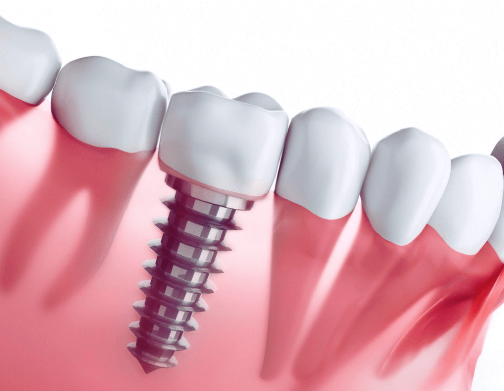インプラントについてmicデンタル沖縄インプラント