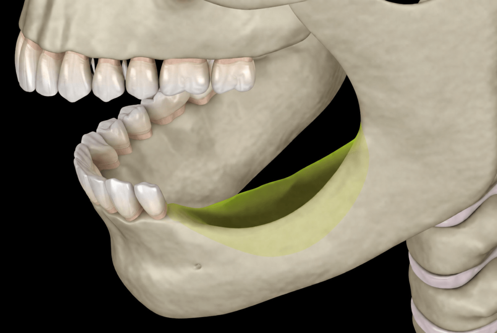 インプラント沖縄Micデンタル垂直的GBR
