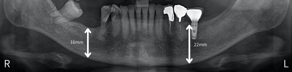 インプラント沖縄micデンタルクリニックGBR