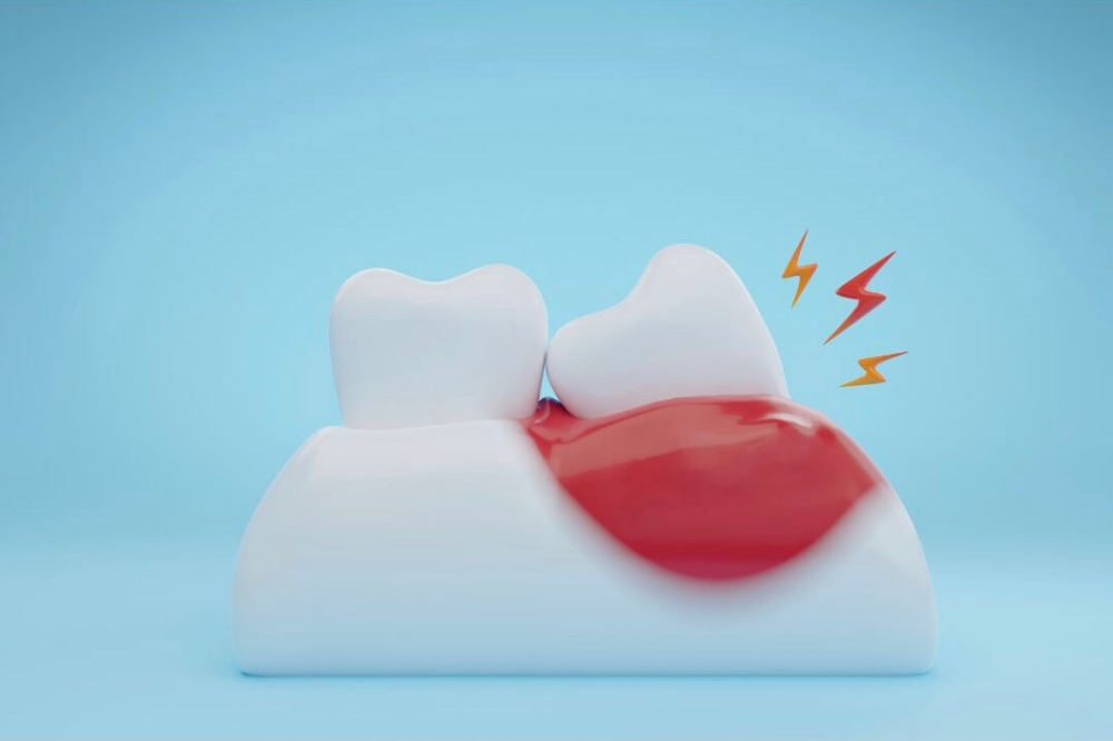 歯周病治療Micデンタルクリニック沖縄インプラント