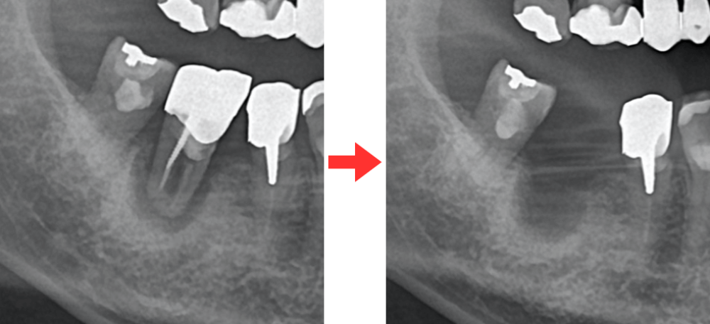 インプラント沖縄micデンタルクリニック歯根嚢胞