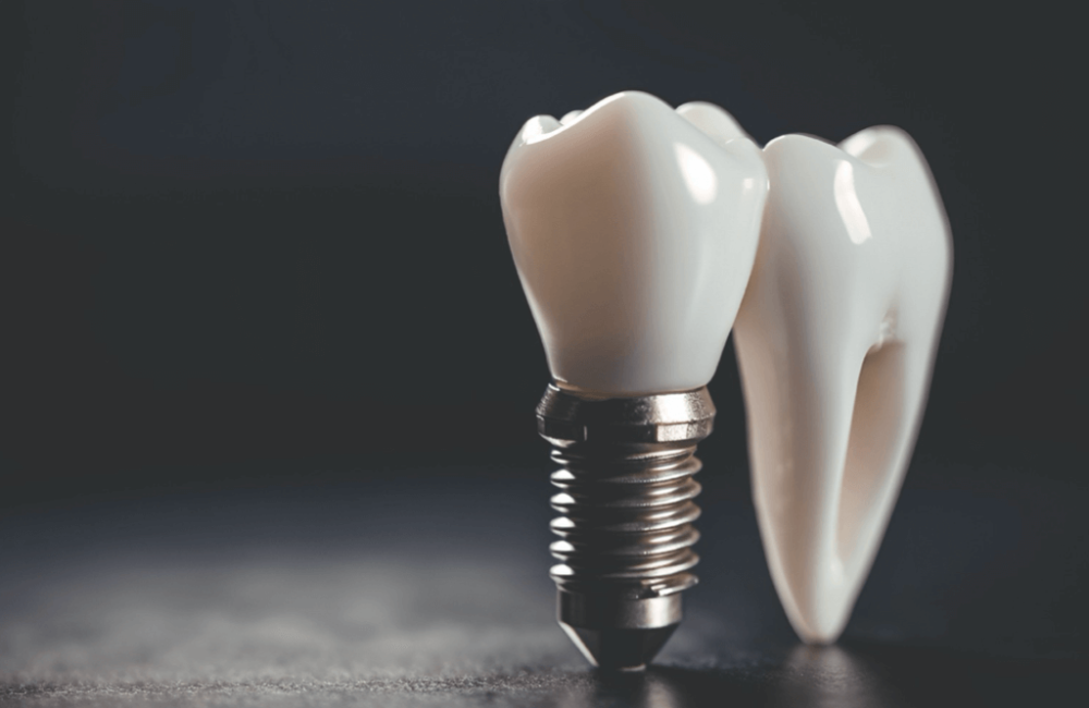 沖縄インプラントmicデンタル費用