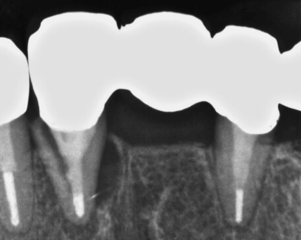 ブリッジについてmicデンタル沖縄インプラント