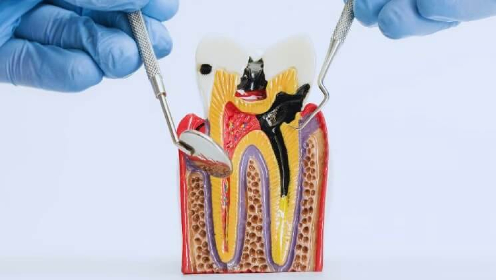 虫歯早期発見Micデンタルクリニック沖縄インプラント