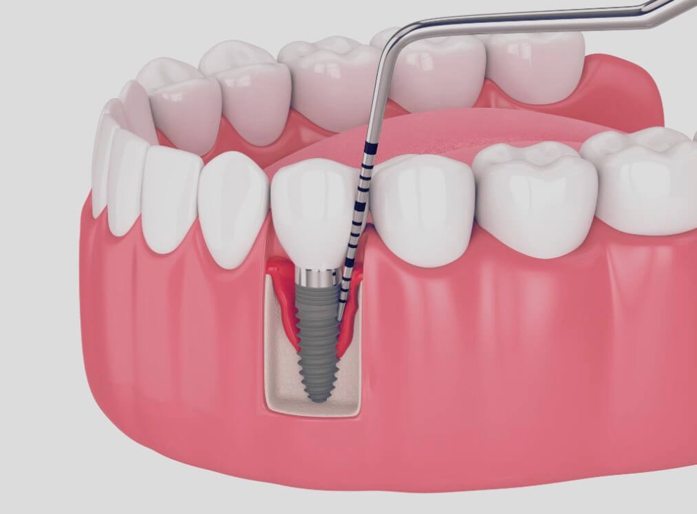 インプラント周囲炎Micデンタル沖縄インプラント