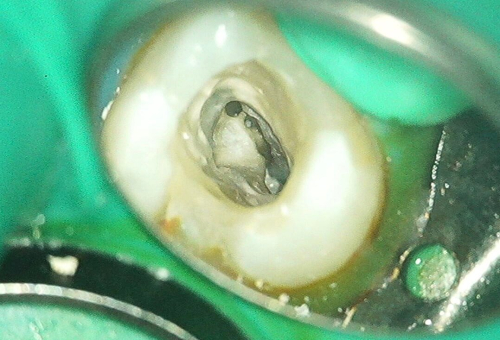 根管治療Micデンタルクリニック沖縄インプラント