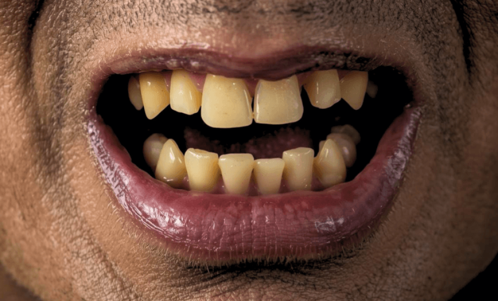 沖縄インプラントMicデンタルすきっ歯