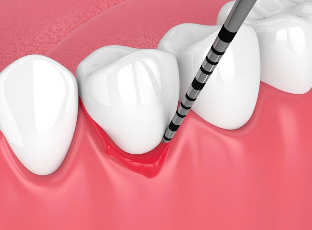 歯周病治療micデンタル沖縄浦添