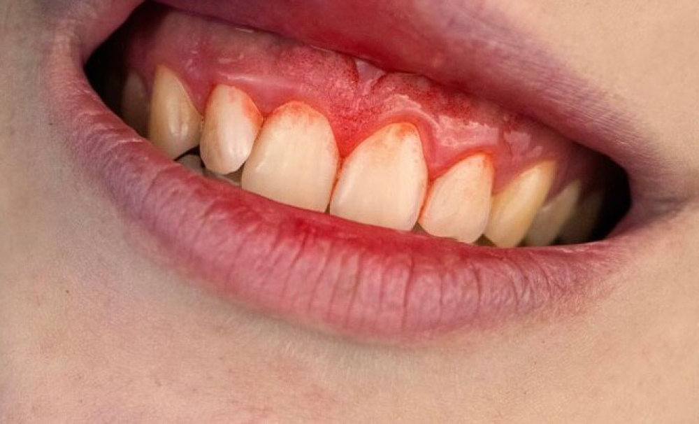 歯槽膿漏micデンタル沖縄インプラント