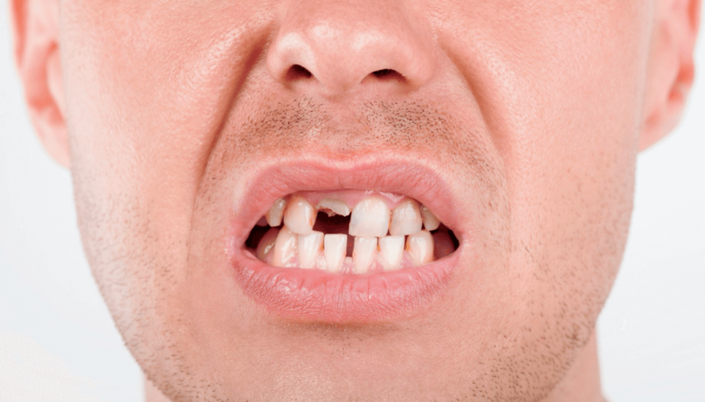 歯がボロボロMicデンタル沖縄インプラント