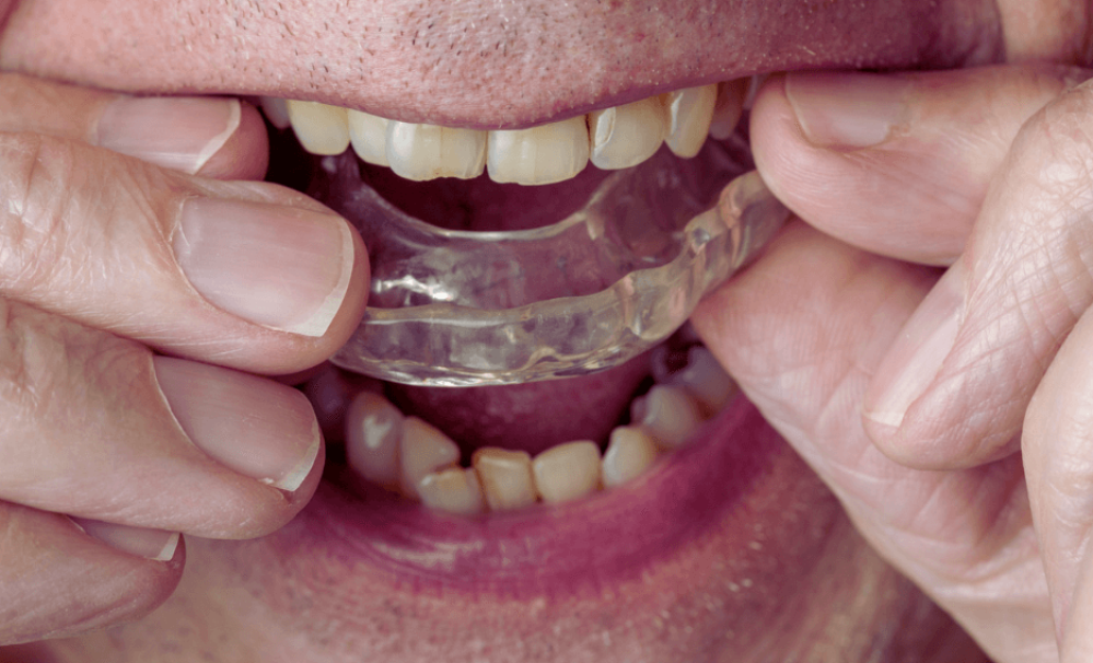 歯ぎしりナイトガードmicデンタル沖縄インプラント