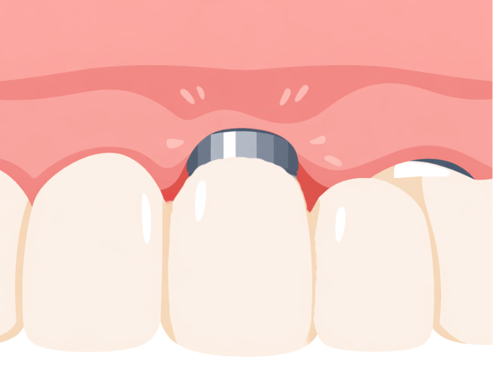 インプラント沖縄micデンタル専門医
